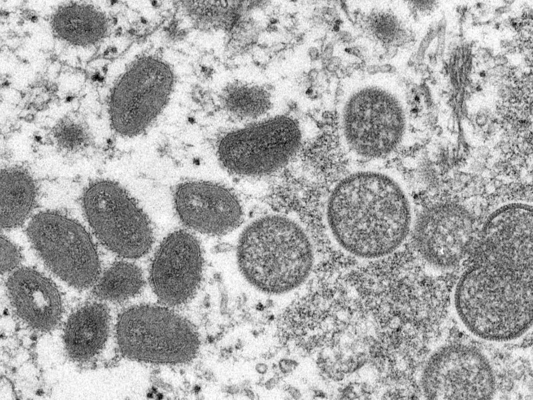 Washington Confirms State’s First Monkeypox Diagnosis